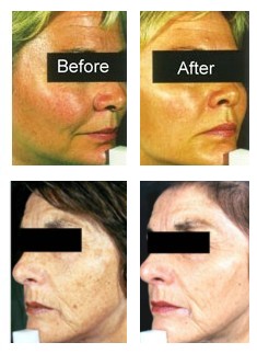 Sun Damaged Skin Treatment: Facial treatments are the most popular, but all parts of the body can be treated.